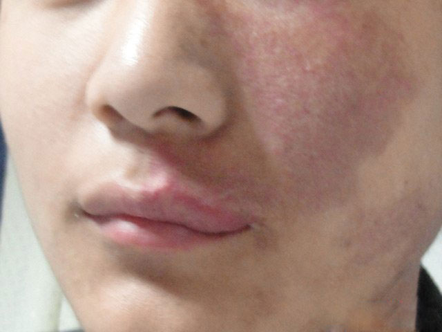 <b>【医生讲解】成年人血管瘤</b>